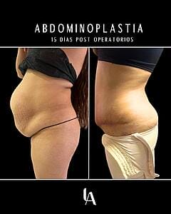6904b4da18220_Abdominoplastía Luis Aguilar cirujano plastico