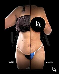 6904b4da46a60_Antes y despues Luis Aguilar cirujano plastico