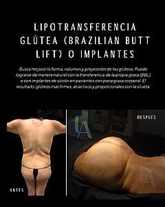 6904b4da78276_Butt implantes Luis Aguilar cirujano plastico