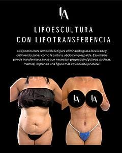 6904b534dc39e_Lipoescultura con lipotrasnferencia Luis Aguilar cirujano plastico