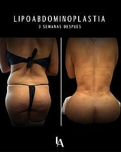 6904b56580cdc_Lipoabdominoplastia Luis Aguilar cirujano plastico
