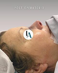6904bc9bdde4c_Dr luis aguilar cirujano plastico postoperatorio